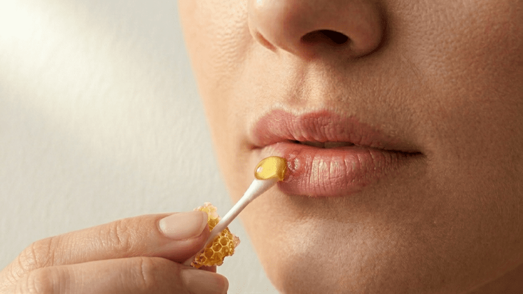 Natural honey applied as a soothing remedy for cold sore treatment