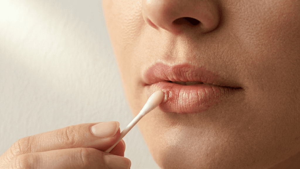 Lemon balm cream used as a natural remedy for cold sore outbreaks